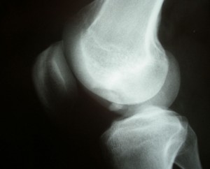 Χόνδρινες – Οστεοχόνδρινες βλάβες του γόνατος