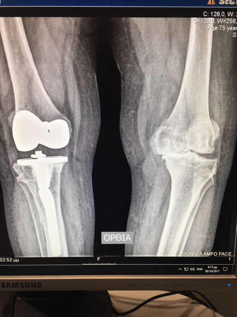 Μετεγχειρητική ακτινογραφία δεξιού γόνατος της ίδιας ασθενούς