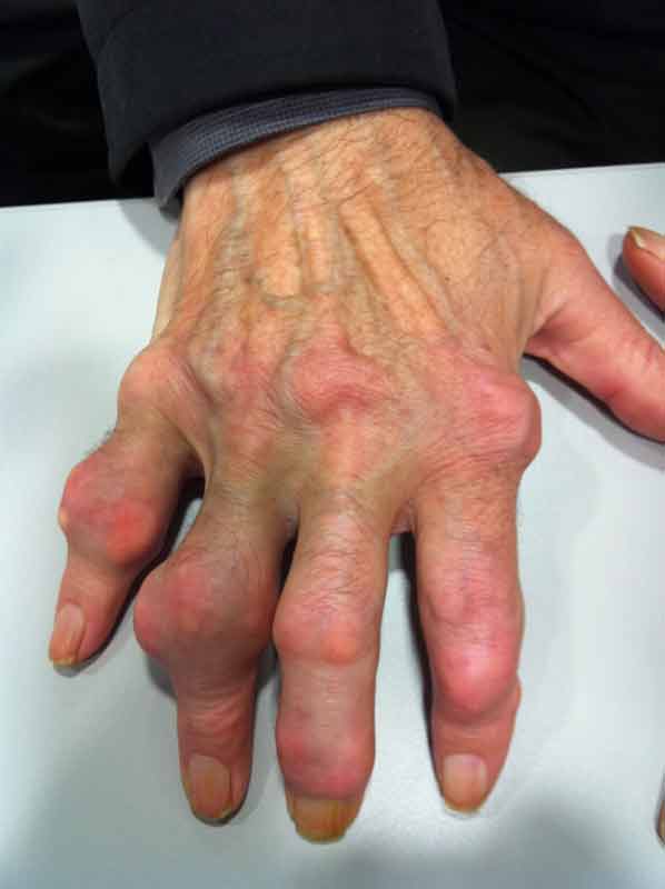 Ασθενής με ουρική αρθρίτιδα χεριών