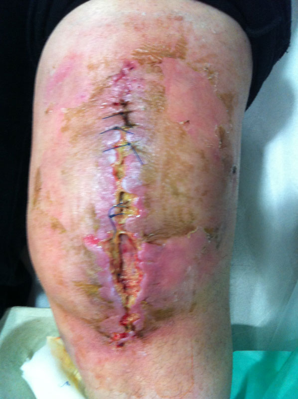 Φλεγμονή Ολικής γόνατος χειρουργηθείσης αλλάχου