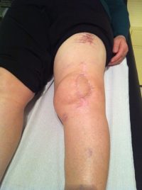 Φλεγμονή Ολικής γόνατος χειρουργηθείσης αλλάχου